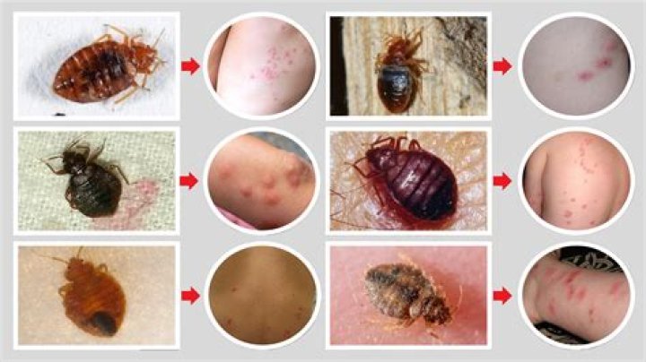 Do bedbugs bite your scalp?