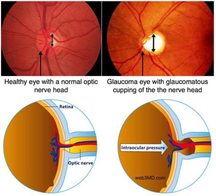 Does large optic nerve mean glaucoma?
