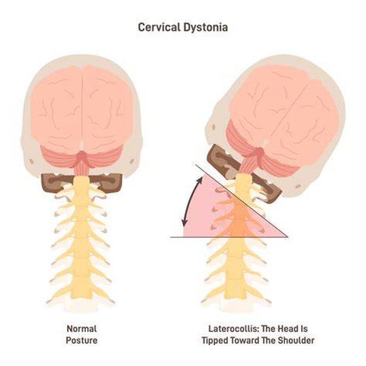 Is torticollis a disability?