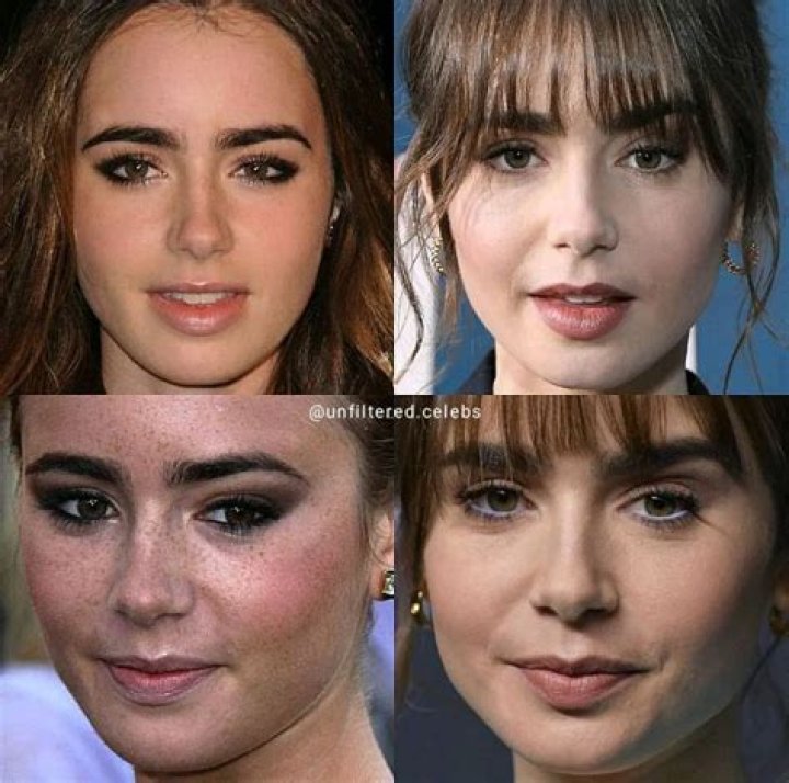 Lily Collins nose job