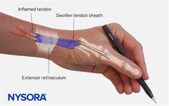 Harry Styles: his relations with ‘One Direction’ band members, career updates, and wrist surgery due to probable tenosynovitis! Source: SciELO (Tenosynovitis in which specific hand movements cause the pain at the place shown)