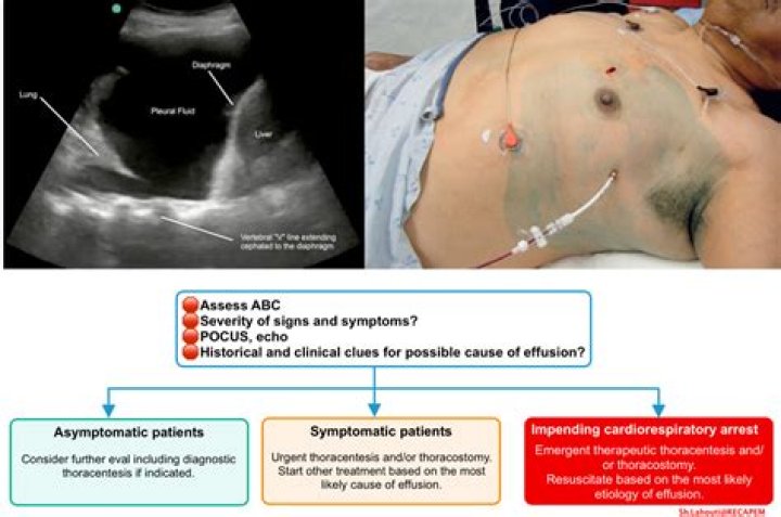 What is the CPT code for pleural effusion drainage?